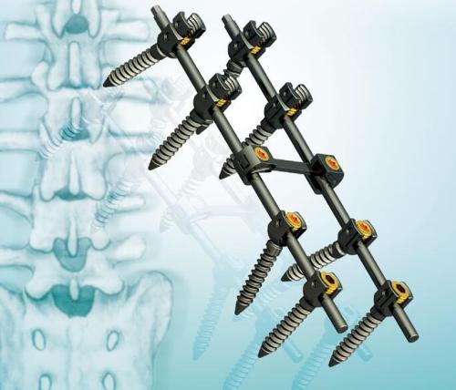骨科耗材带量采购：进口替代红利有待兑现