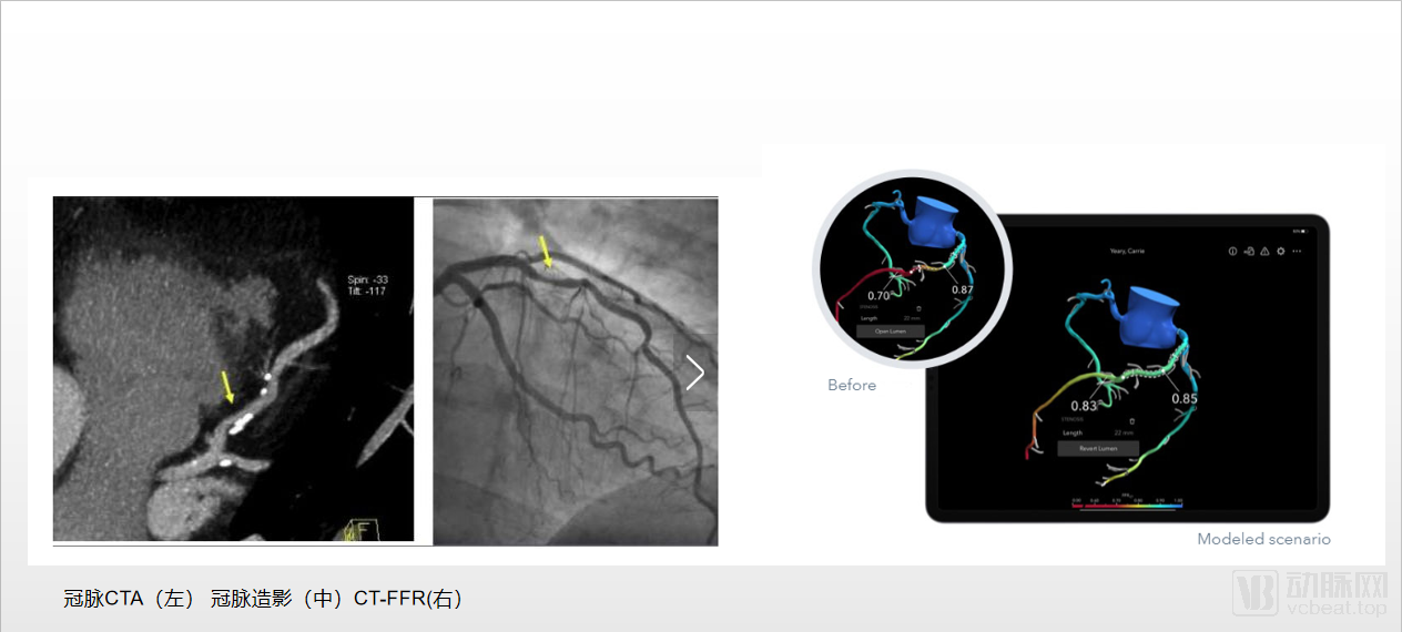 国内超10家企业扎根影像FFR领域，国外诞生独角兽，国内如何追赶？