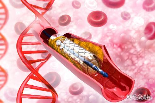 葛均波院士团队：国内最早开始的自主研发生物可吸收支架上市