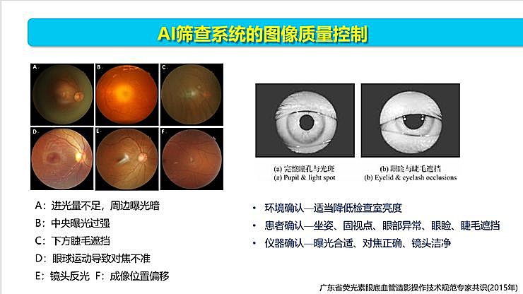 新知图谱, 全国智能眼科学组组长袁进:我们为什么要做一份修改 50 多稿的眼科 AI 筛查指南?